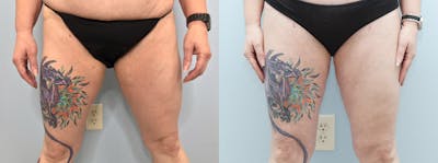 Liposuction Before & After Gallery - Patient 75539940 - Image 1