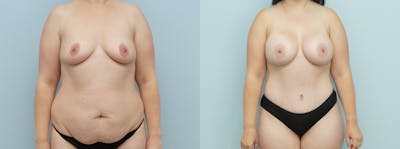 Mommy Makeover Before & After Gallery - Patient 75540043 - Image 1