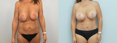 Mommy Makeover Before & After Gallery - Patient 75540061 - Image 1