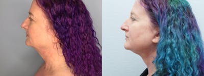Neck Lift Before & After Gallery - Patient 75540075 - Image 1