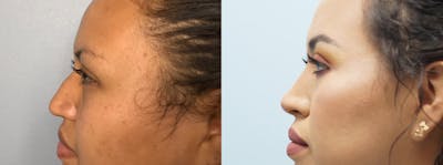 Rhinoplasty  Before & After Gallery - Patient 75540085 - Image 1
