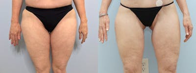 Thigh Lift Before & After Gallery - Patient 75540105 - Image 1