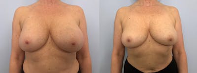 Implant Removal Before & After Gallery - Patient 94917740 - Image 1