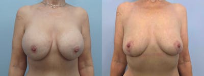 Implant Removal Before & After Gallery - Patient 89841190 - Image 1