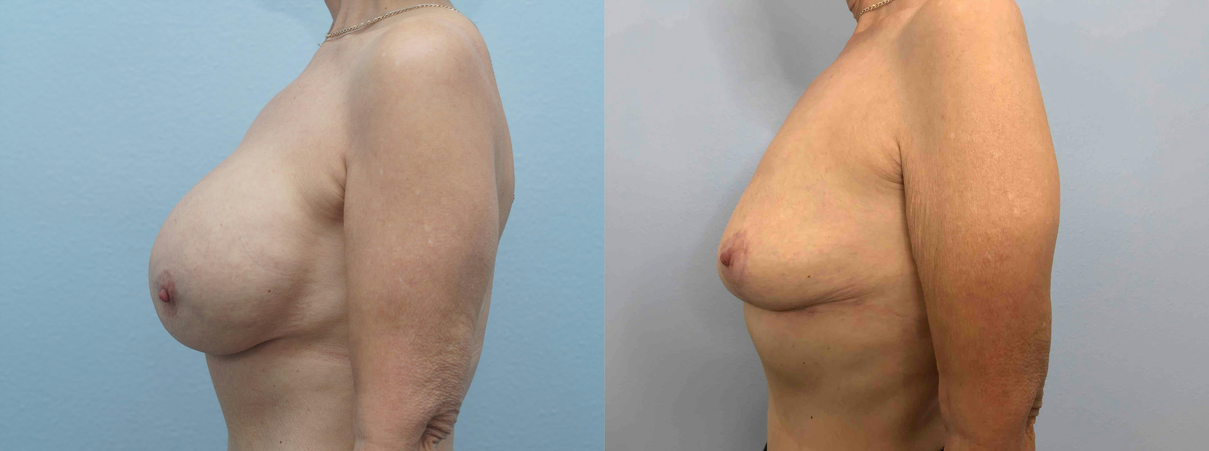 Implant Removal Gallery - Patient 89841190 - Image 5