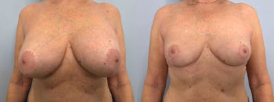 Implant Removal Before & After Gallery - Patient 89841191 - Image 1