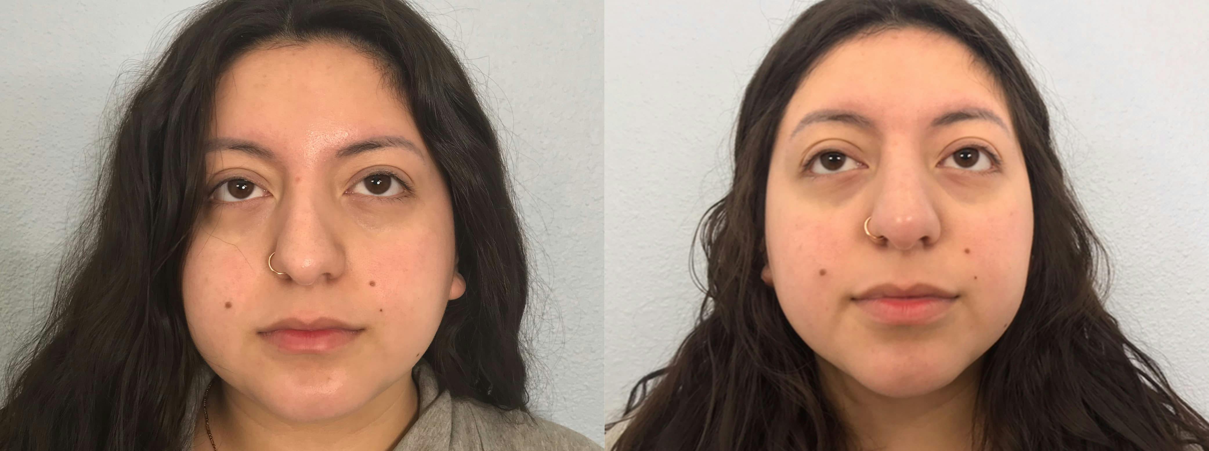 Non-Surgical Rhinoplasty Gallery - Patient 91739405 - Image 2