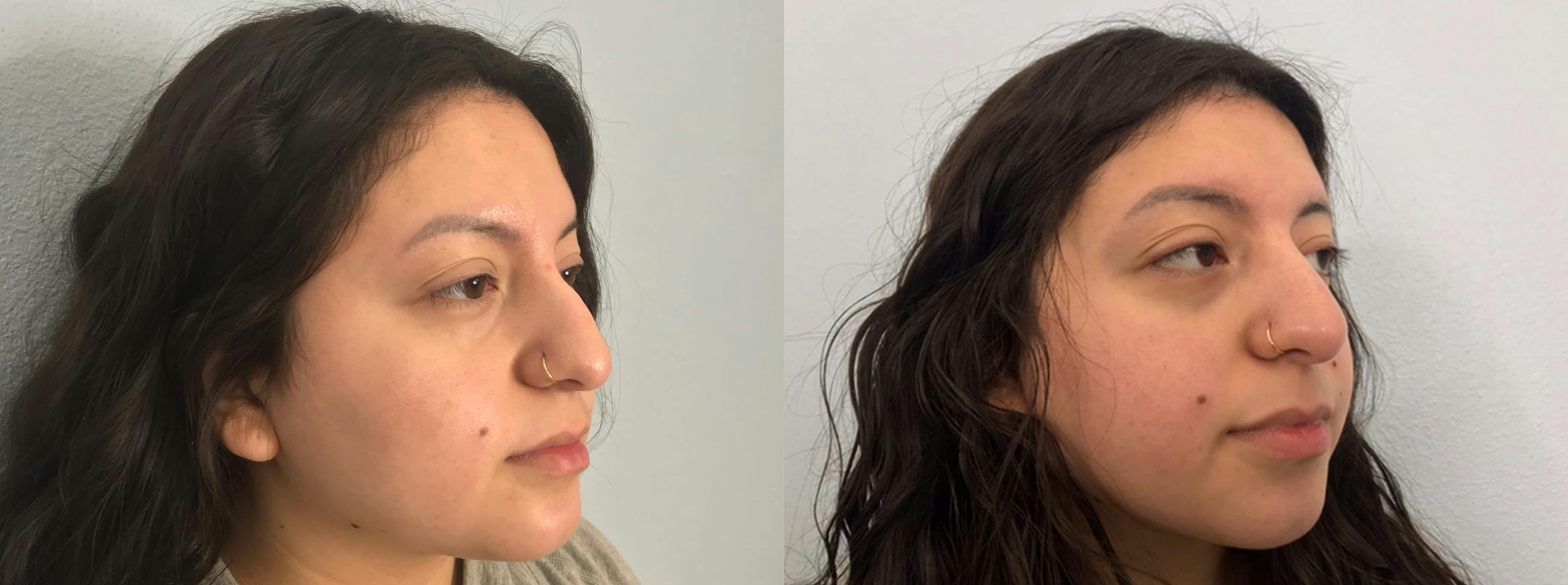 Non-Surgical Rhinoplasty Gallery - Patient 91739405 - Image 3