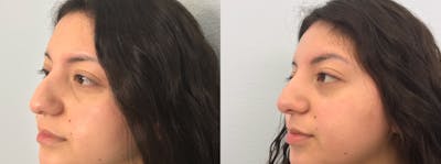 Non-Surgical Rhinoplasty Before & After Gallery - Patient 91739405 - Image 1