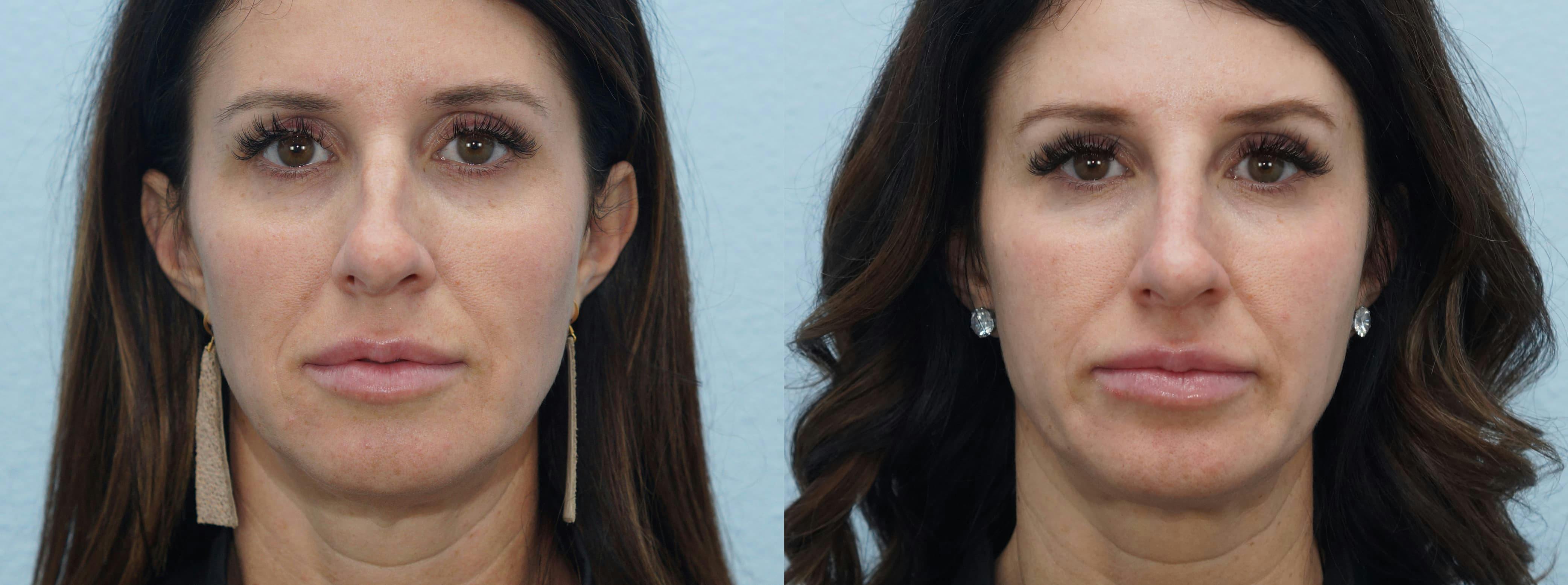 Non-Surgical Rhinoplasty Gallery - Patient 91739406 - Image 2