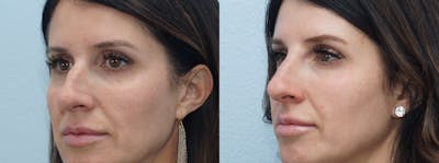 Non-Surgical Rhinoplasty Before & After Gallery - Patient 91739406 - Image 1