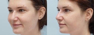 Non-Surgical Rhinoplasty Before & After Gallery - Patient 91739407 - Image 1