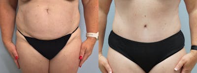 Tummy Tuck Before & After Gallery - Patient 94281130 - Image 1