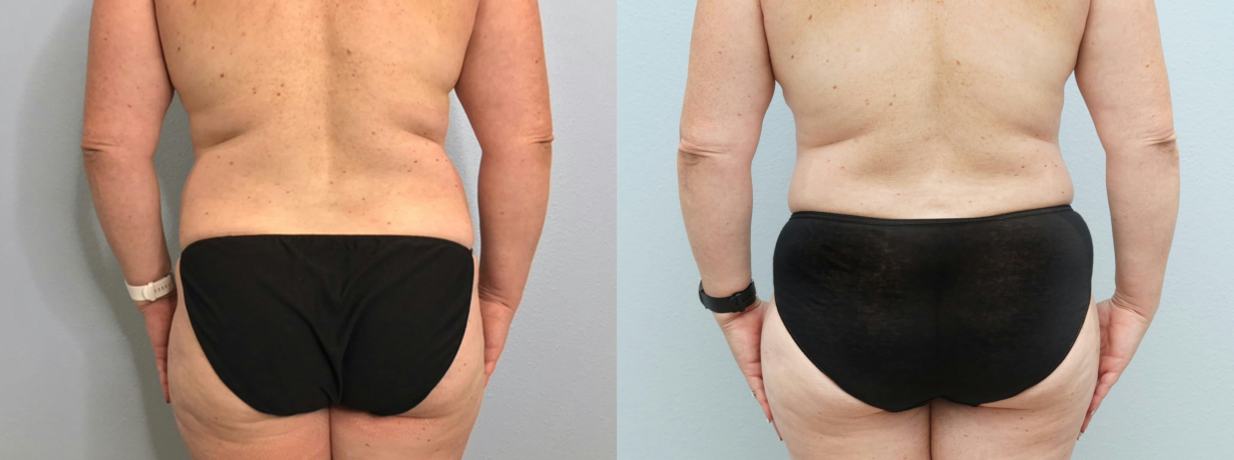 Tummy Tuck Gallery - Patient 94281130 - Image 2