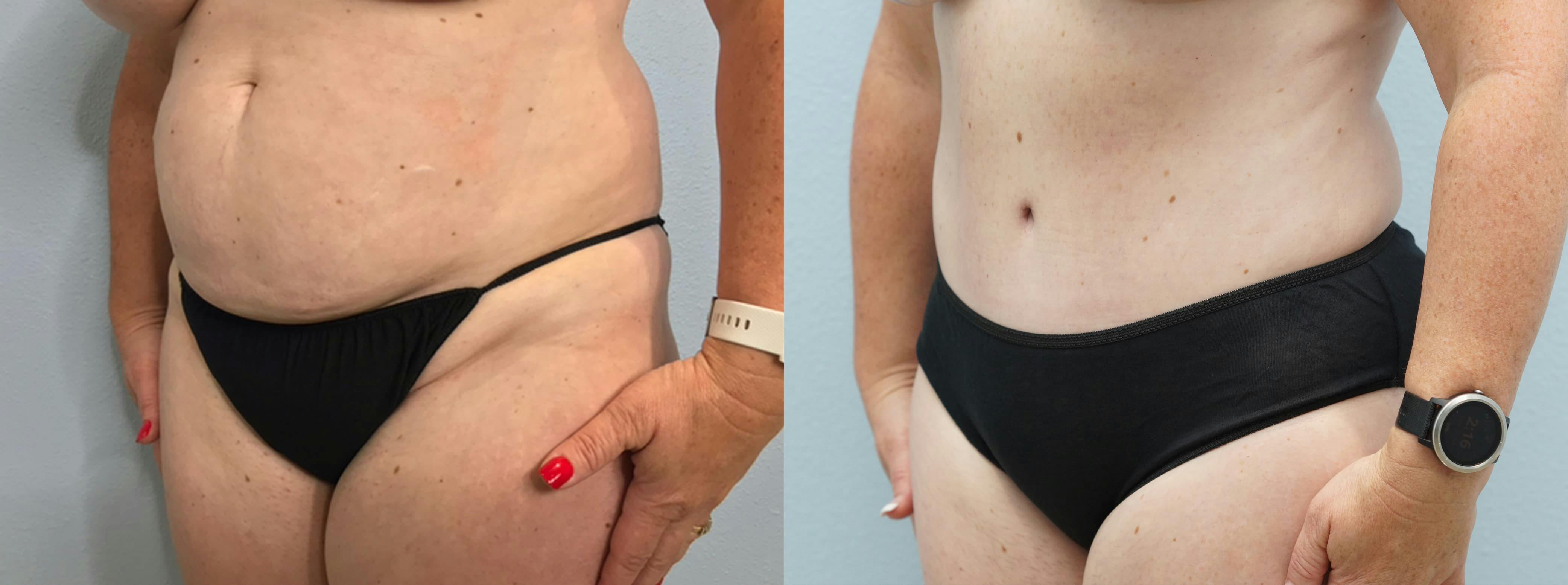 Tummy Tuck Gallery - Patient 94281130 - Image 3