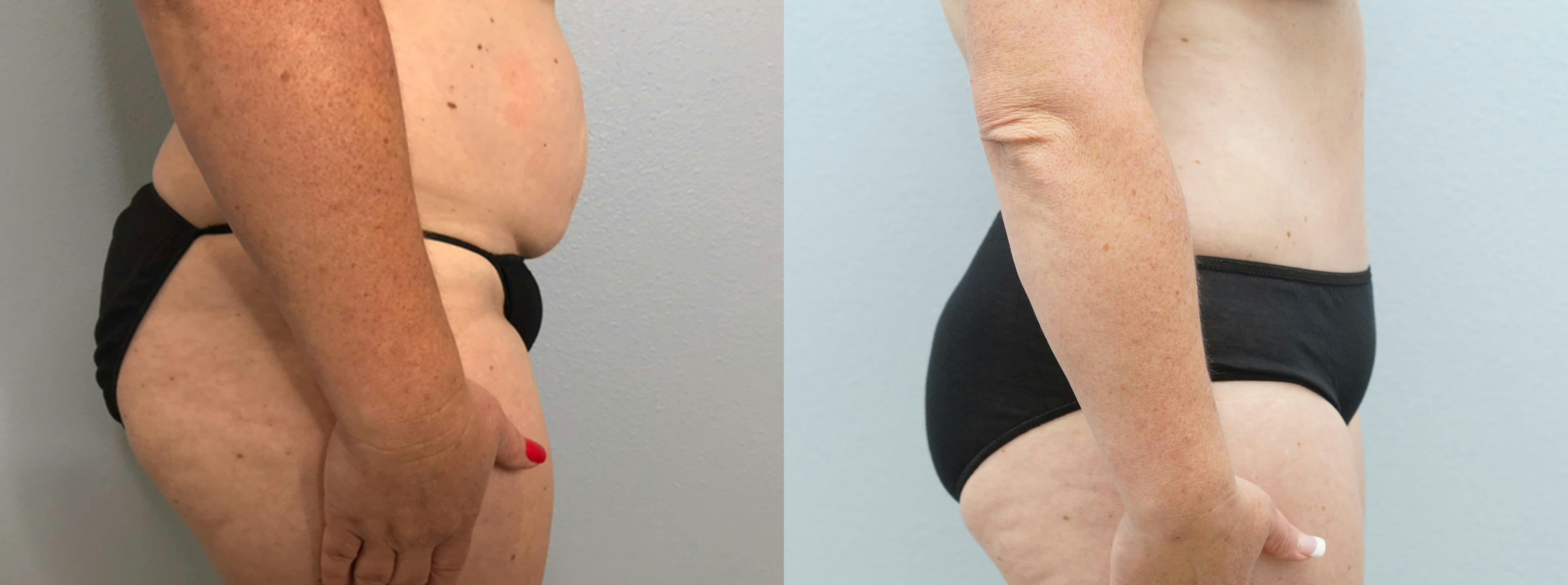 Tummy Tuck Gallery - Patient 94281130 - Image 6