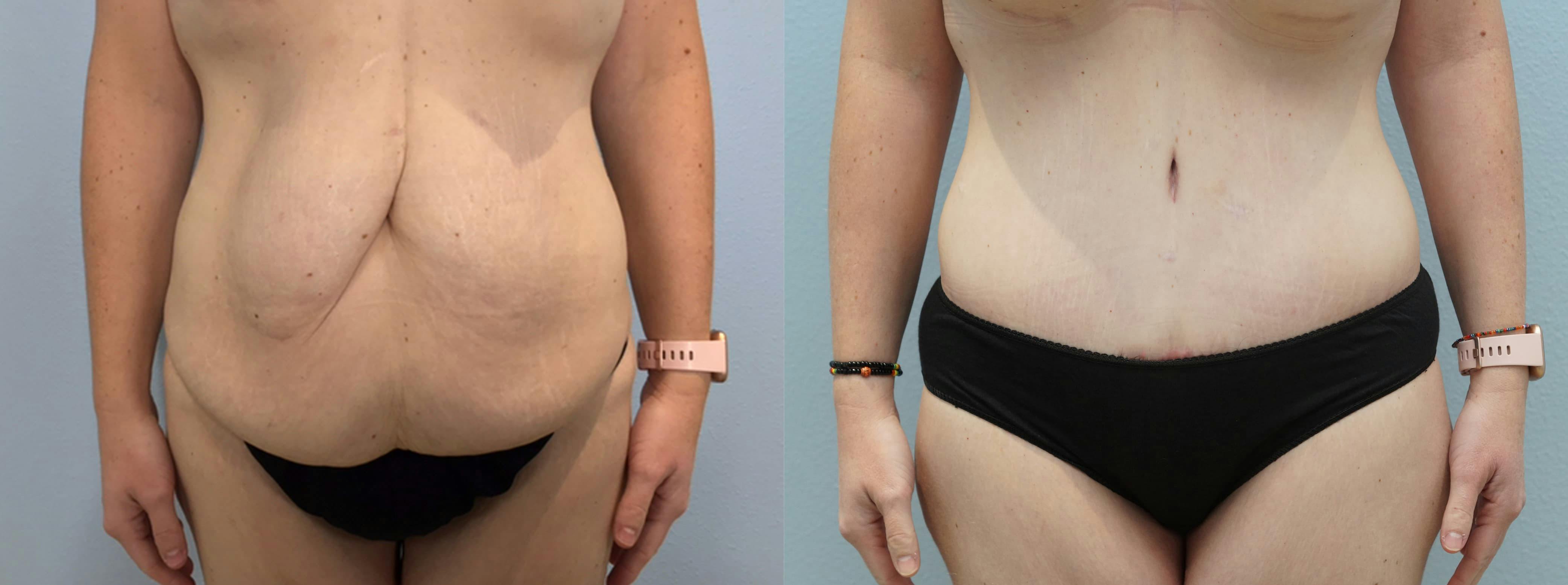 Tummy Tuck Gallery - Patient 94281145 - Image 1