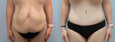 Tummy Tuck Before & After Gallery - Patient 94281145 - Image 1