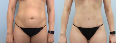 Tummy Tuck Before & After Gallery - Patient 94281164 - Image 1