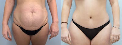 Tummy Tuck Before & After Gallery - Patient 94281220 - Image 1