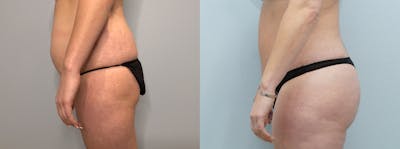 Brazilian Butt Lift Before & After Gallery - Patient 94281303 - Image 1