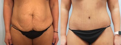 Body Lift Before & After Gallery - Patient 94297451 - Image 1