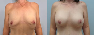 Breast Augmentation Before & After Gallery - Patient 94297509 - Image 1