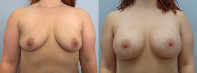 Breast Augmentation Before & After Gallery - Patient 94297627 - Image 1