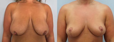 Breast Lift Before & After Gallery - Patient 94297667 - Image 1