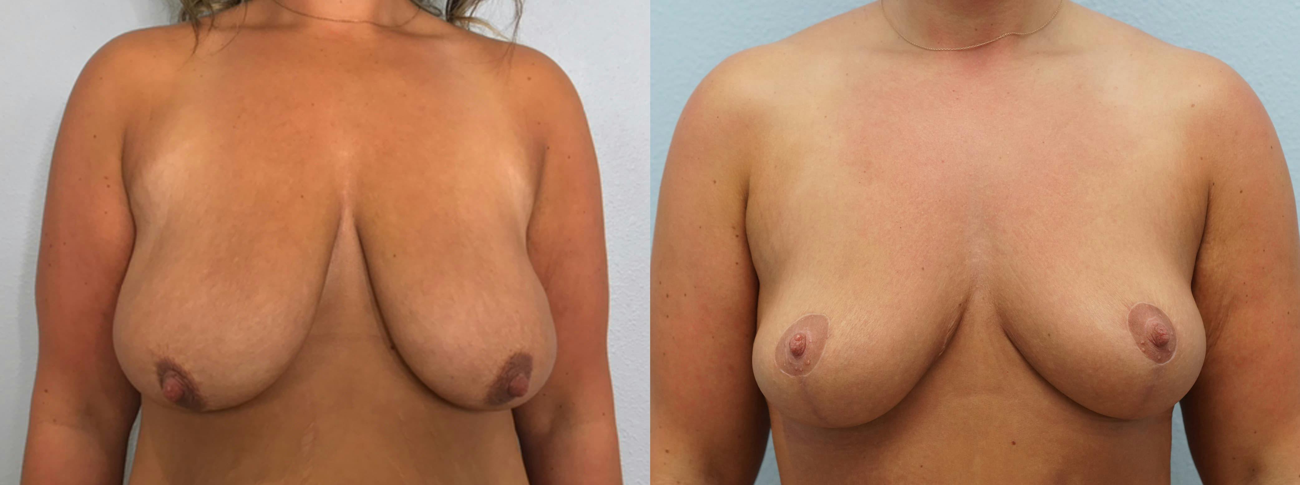 Breast Lift Gallery - Patient 94297667 - Image 1