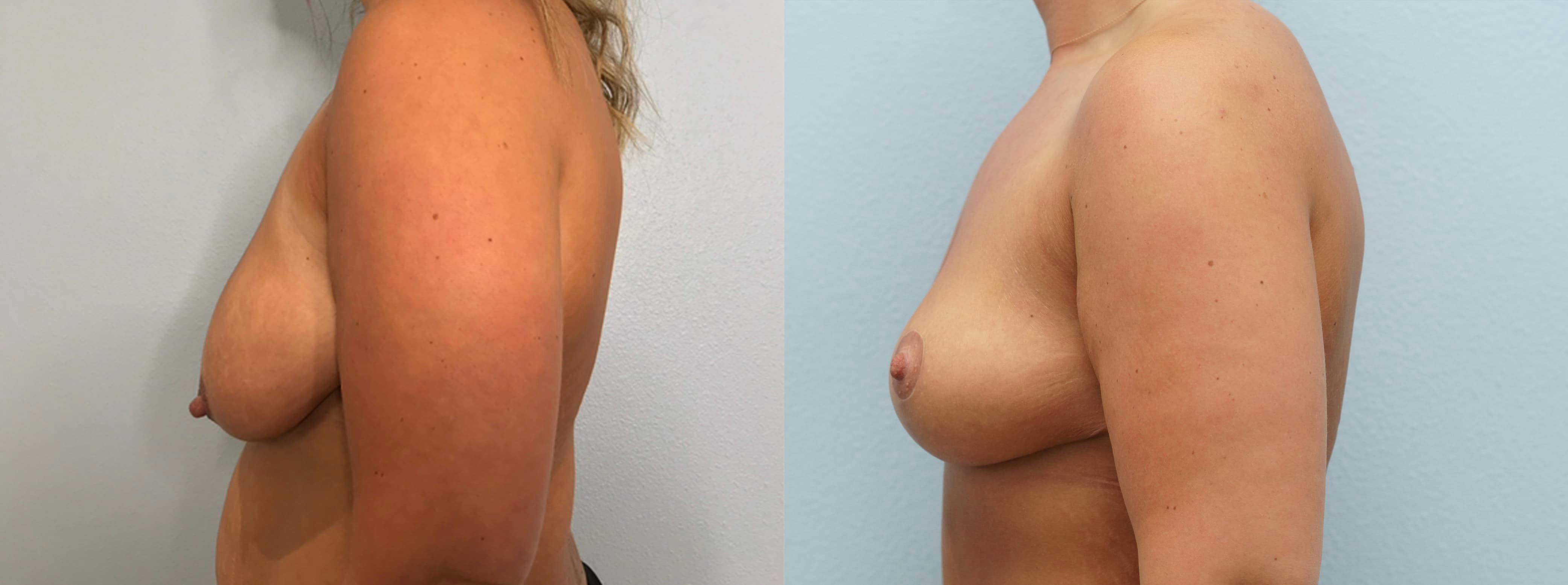 Breast Lift Gallery - Patient 94297667 - Image 2