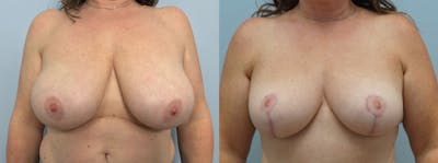 Breast Reduction Before & After Gallery - Patient 94298046 - Image 1