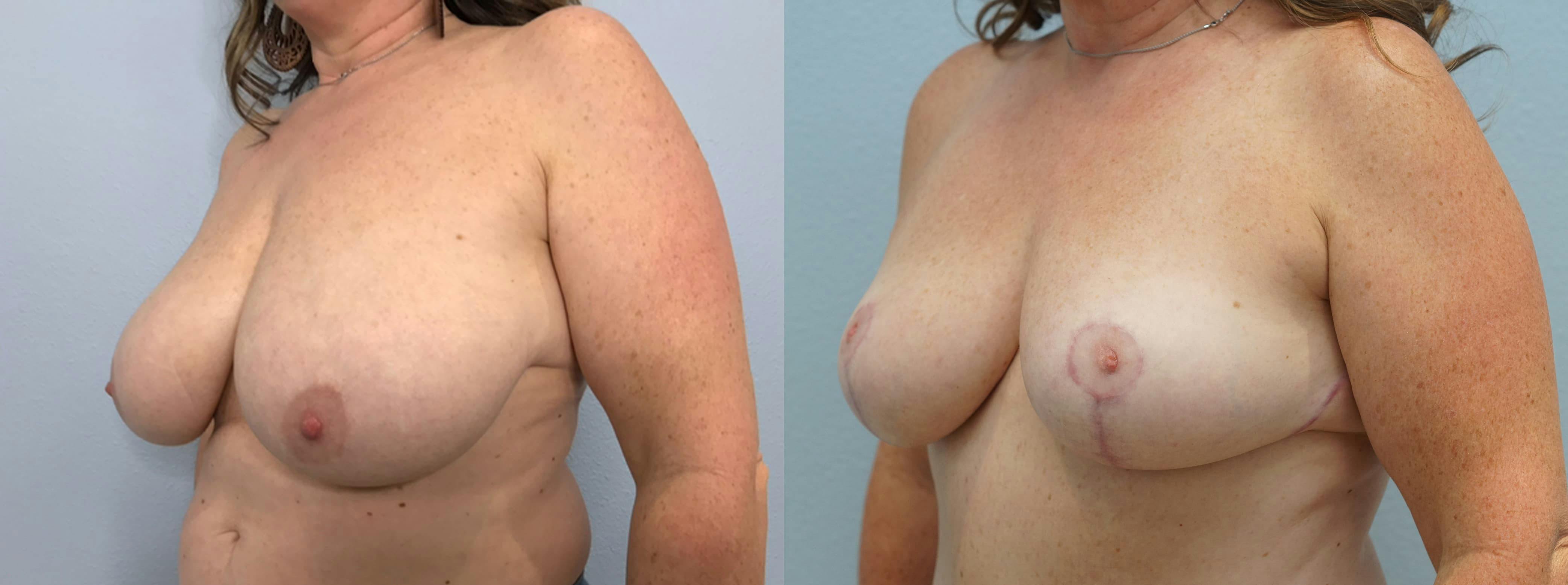 Breast Reduction Gallery - Patient 94298046 - Image 2