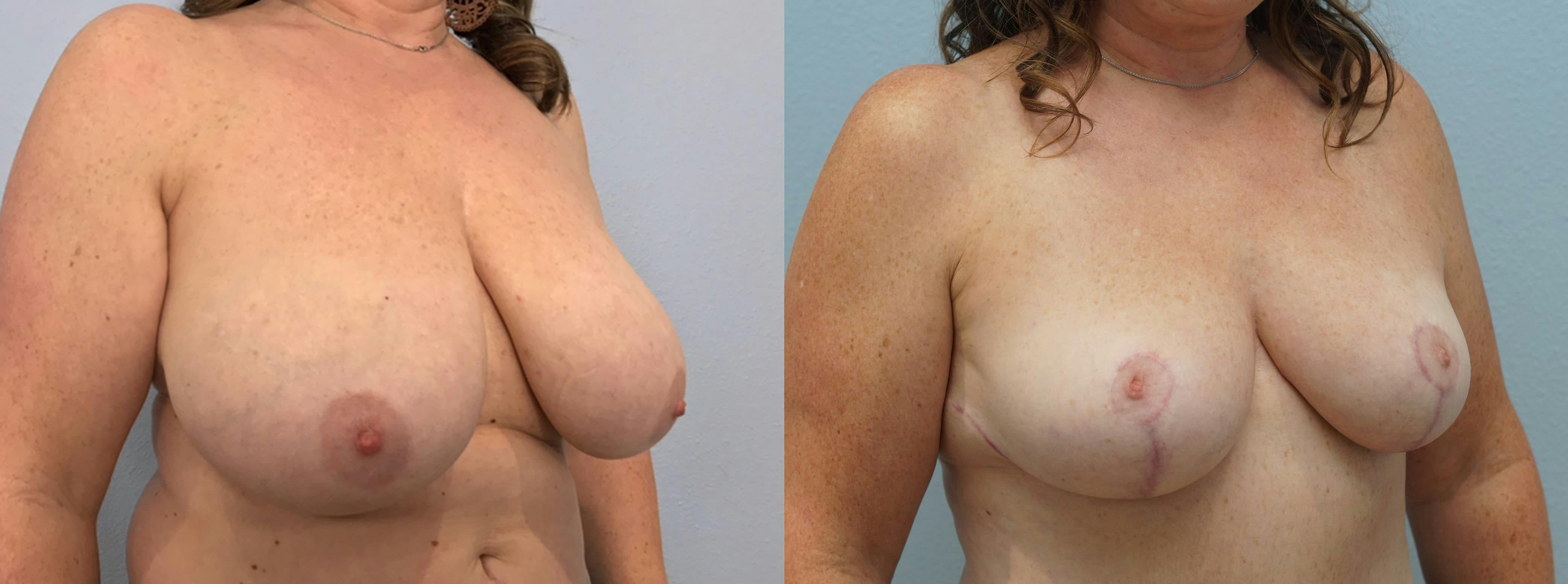 Breast Reduction Gallery - Patient 94298046 - Image 4