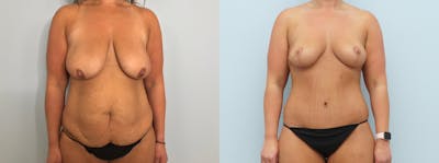 Mommy Makeover Before & After Gallery - Patient 94313136 - Image 1