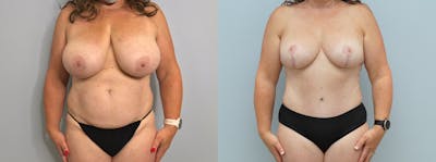 Mommy Makeover Before & After Gallery - Patient 94313165 - Image 1
