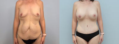 Mommy Makeover Before & After Gallery - Patient 94313202 - Image 1