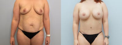 Mommy Makeover Before & After Gallery - Patient 94313550 - Image 1