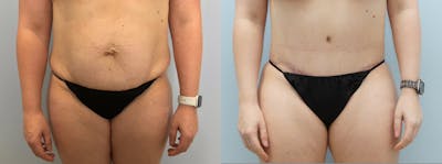 Tummy Tuck Before & After Gallery - Patient 94313594 - Image 1