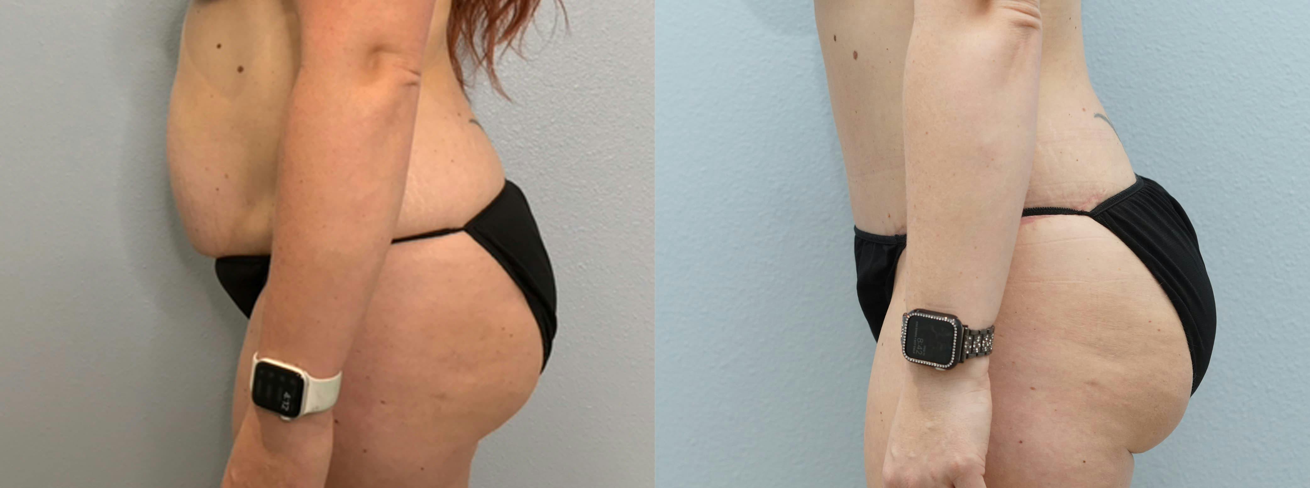 Tummy Tuck Gallery - Patient 94313594 - Image 4