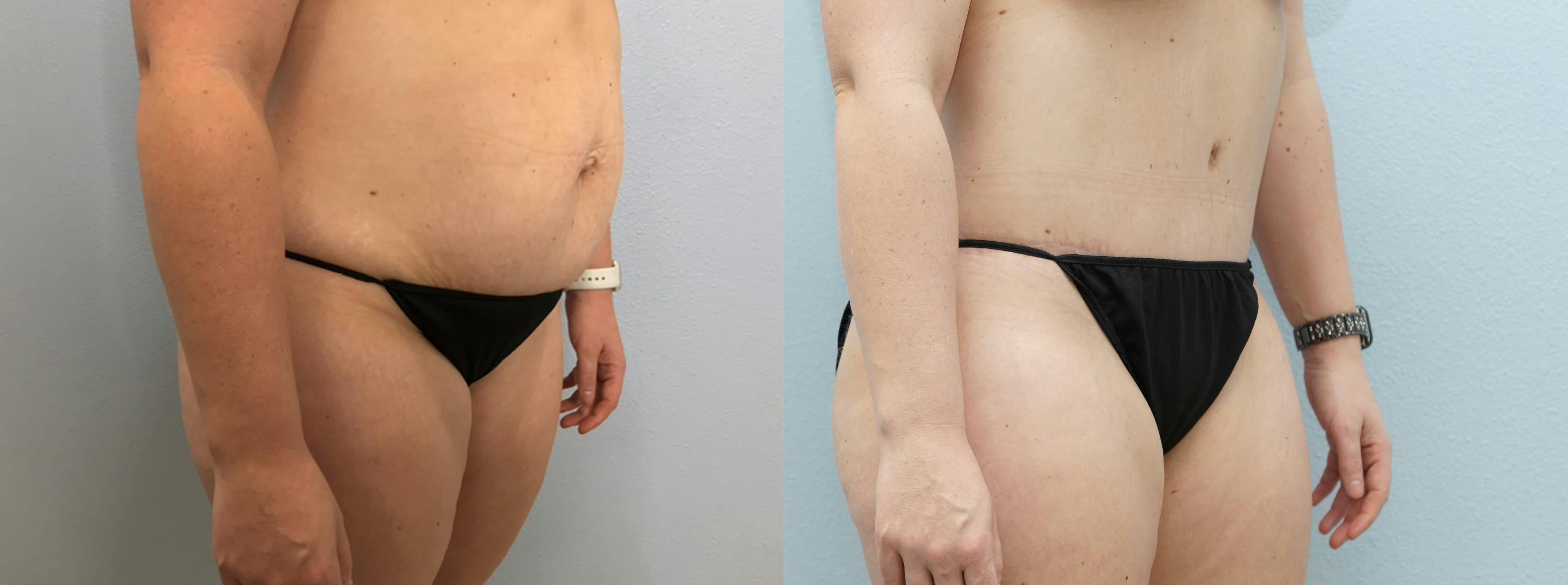 Tummy Tuck Gallery - Patient 94313594 - Image 5