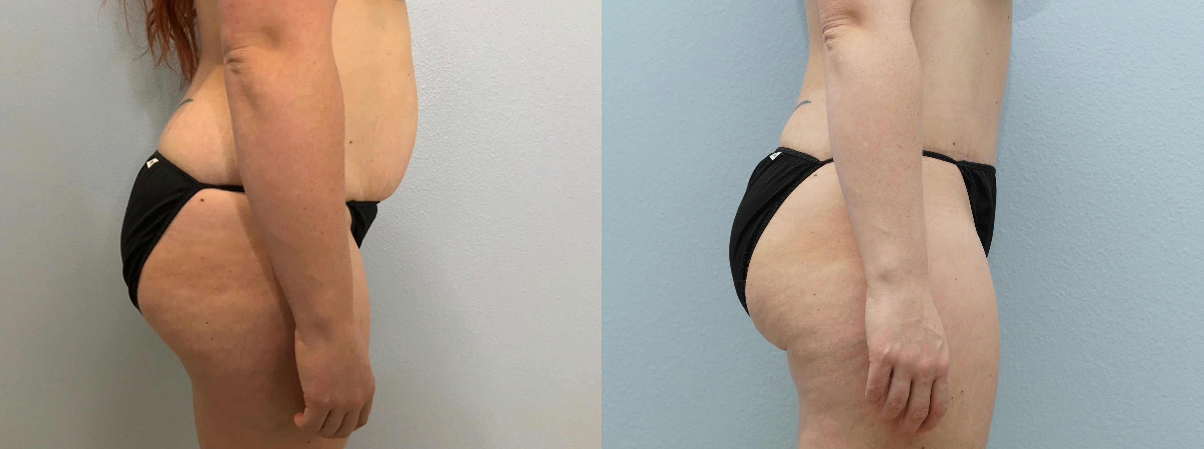 Tummy Tuck Gallery - Patient 94313594 - Image 6
