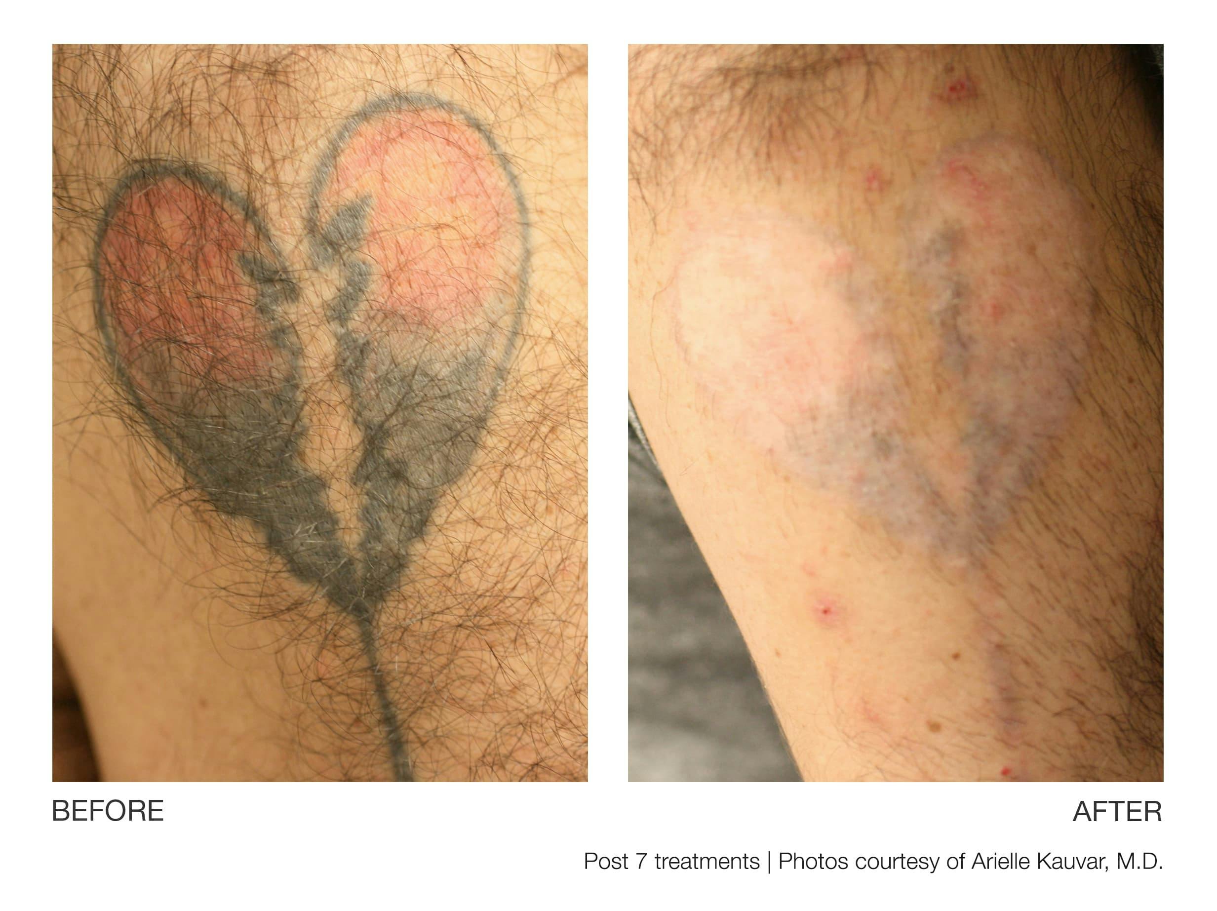 Tattoo Removal Gallery - Patient 94033529 - Image 1