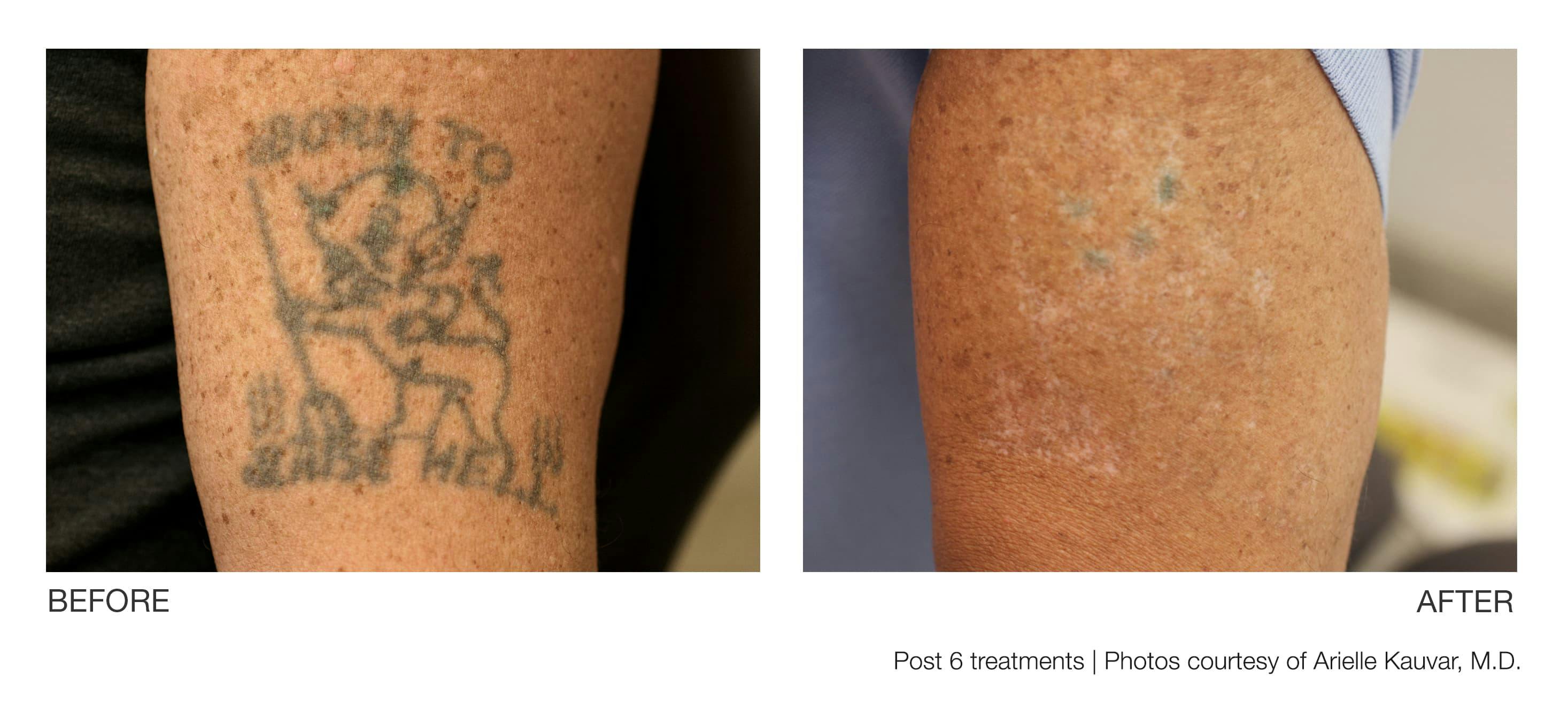 Tattoo Removal Gallery - Patient 94033530 - Image 1