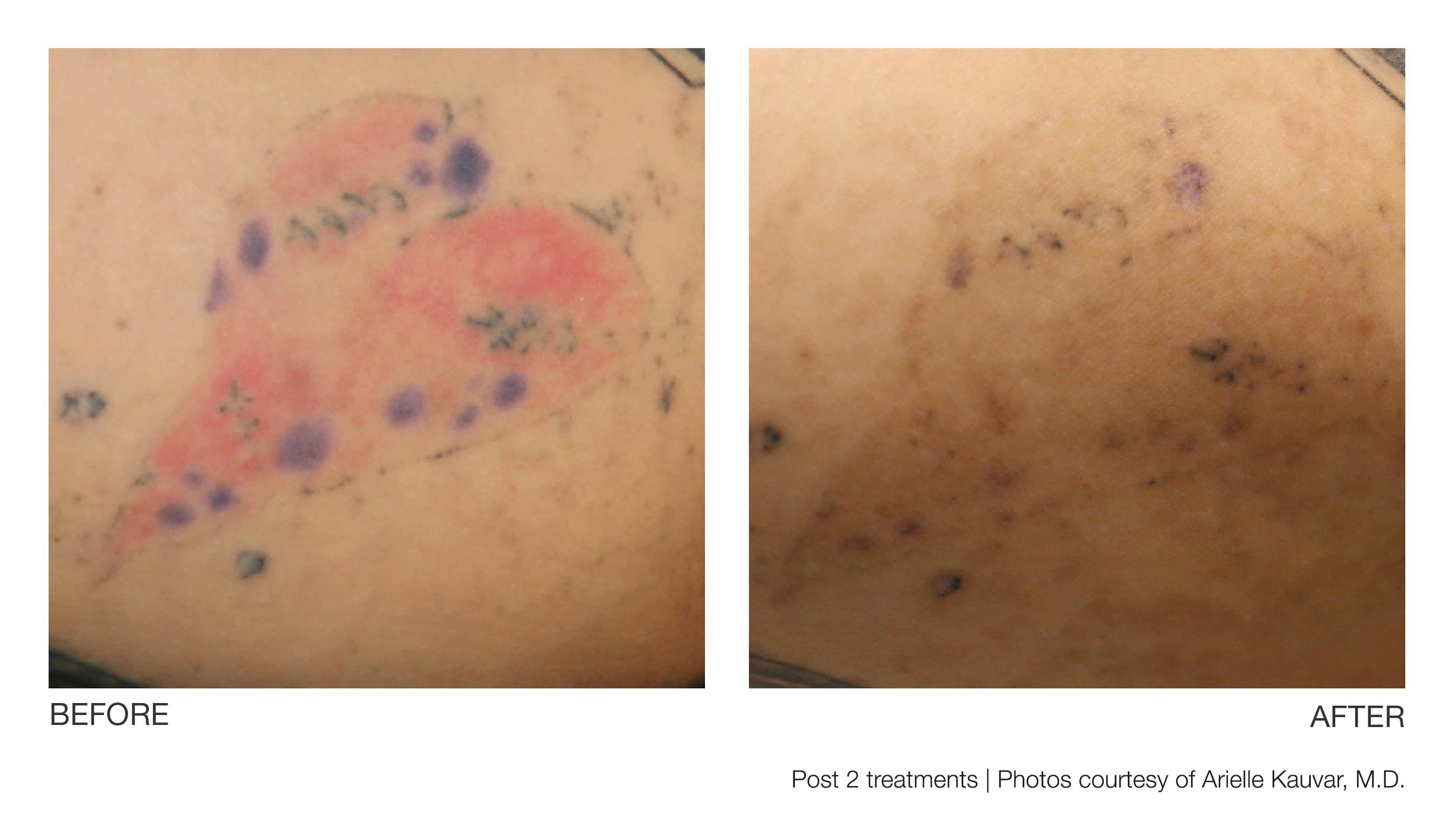 Tattoo Removal Gallery - Patient 94033572 - Image 1