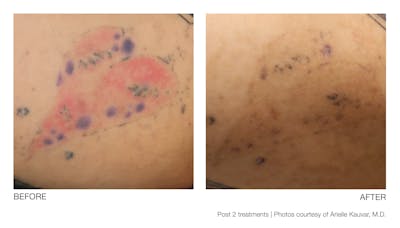 Tattoo Removal Before & After Gallery - Patient 94033572 - Image 1