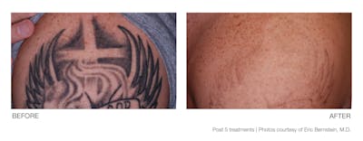 Tattoo Removal Before & After Gallery - Patient 94033573 - Image 1