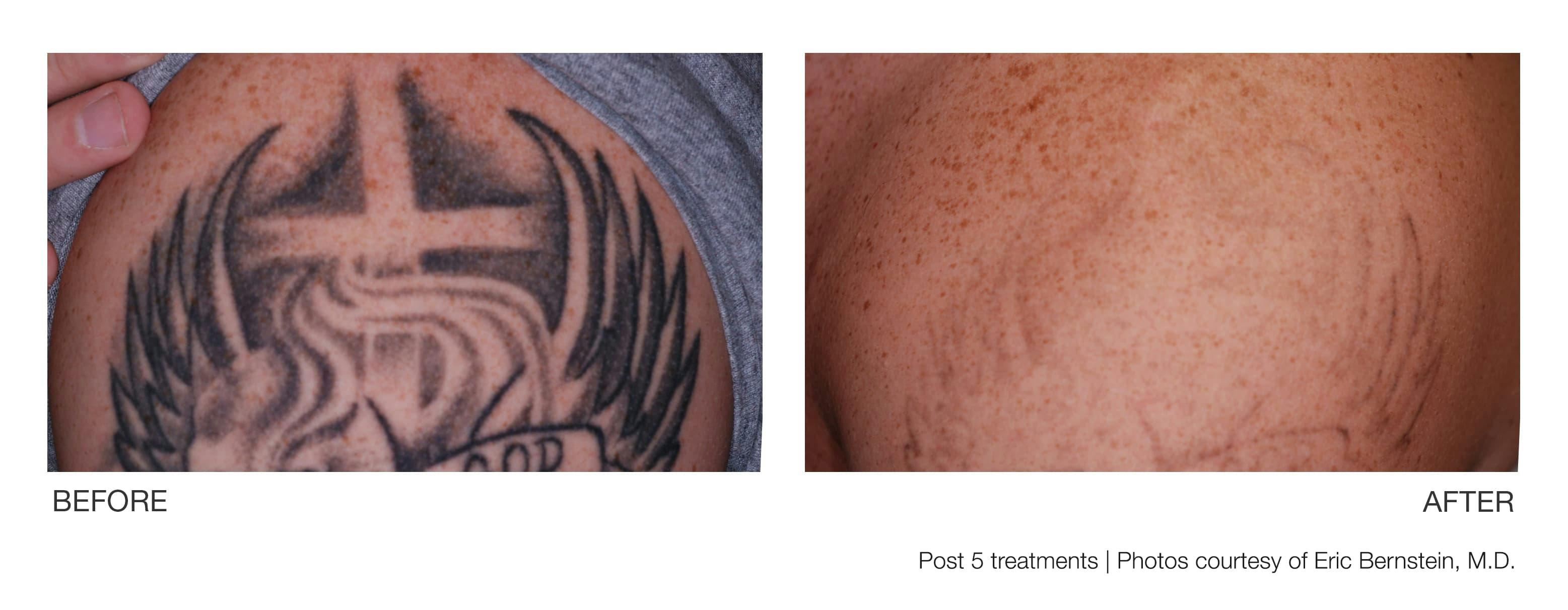 Tattoo Removal Gallery - Patient 94033573 - Image 1