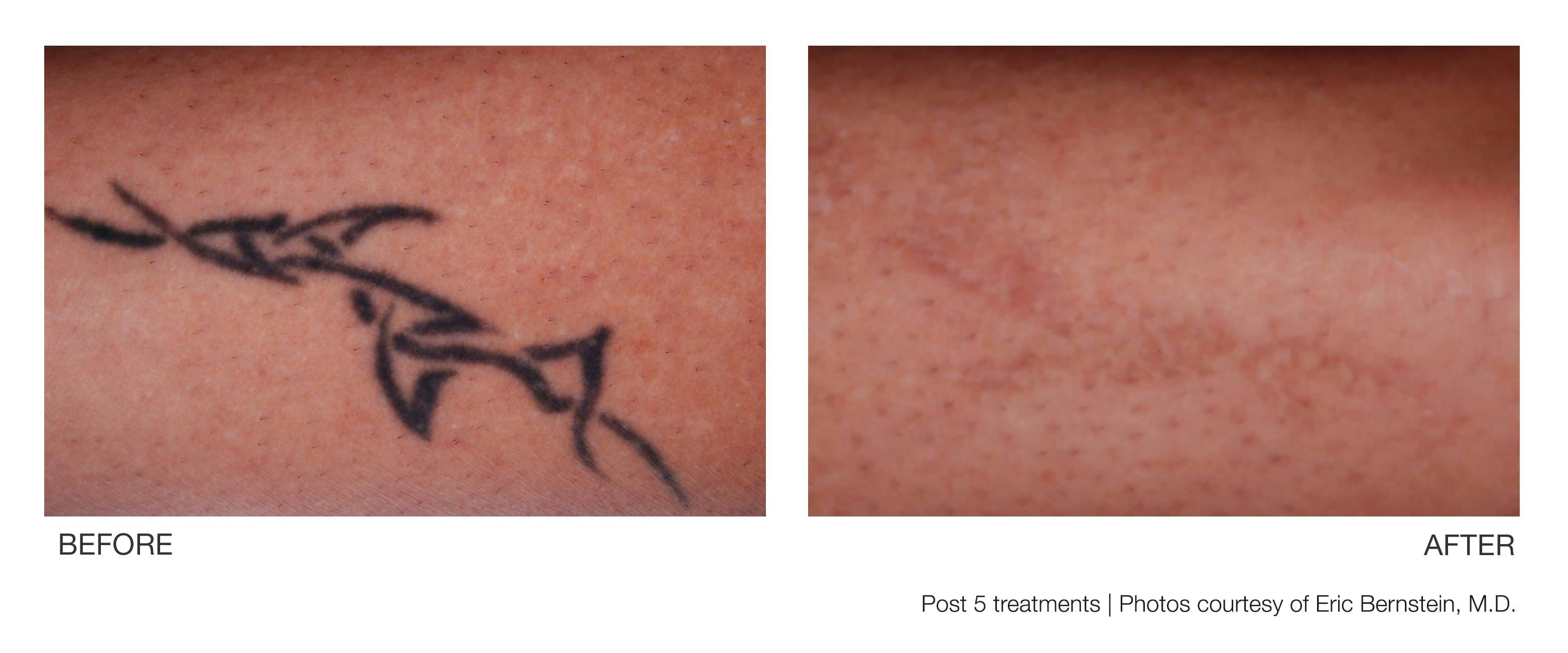 Tattoo Removal