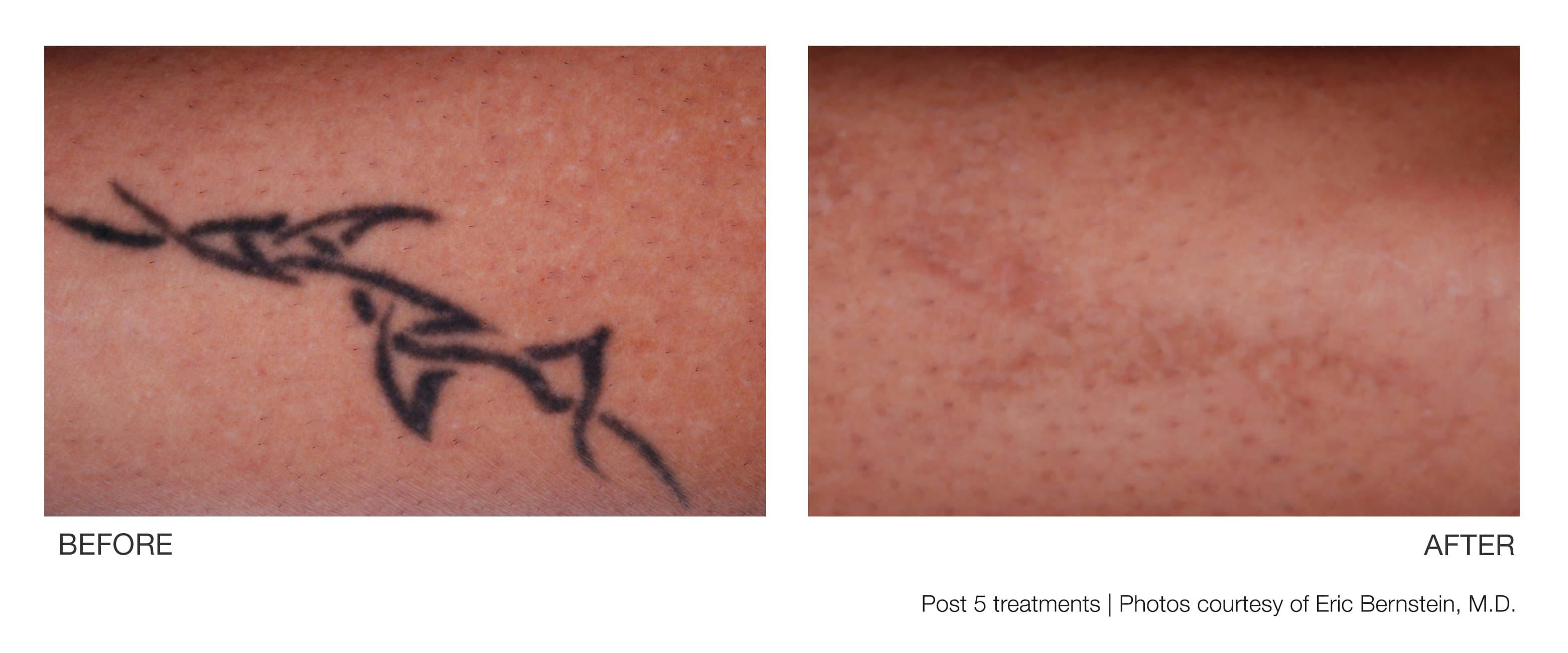 Tattoo Removal Gallery - Patient 94033574 - Image 1